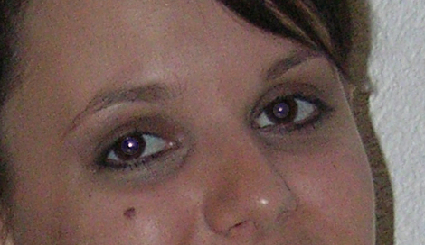 Resultat beide Pupillen